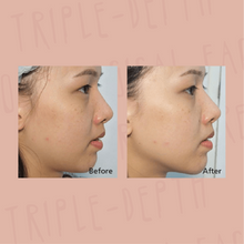 Load image into Gallery viewer, HIFU NECK LIFT + DOUBLE CHIN REDUCTION
